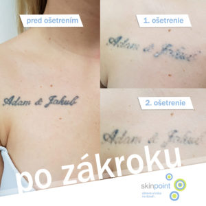 odstranenie tetovania hruď žena